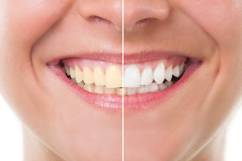 Teeth Whitening - Quimson Dental Care, San Francisco Dentist