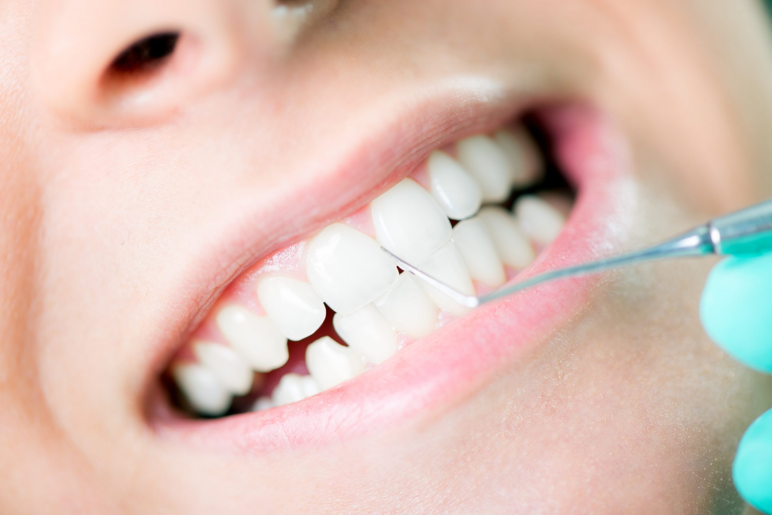 teeth cleaning in san francisco